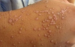 扁平疣的护理患者切忌抓挠患处