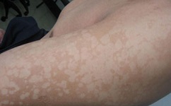 患了花斑癣应注意保持皮肤清洁