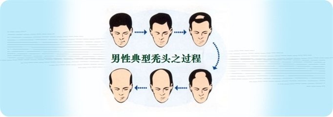 长沙秃顶治疗医院